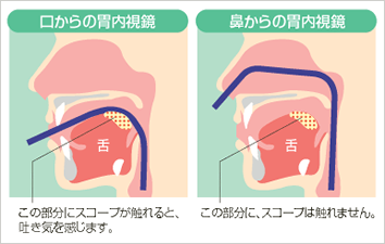 口からの胃内視鏡　鼻からの胃内視鏡